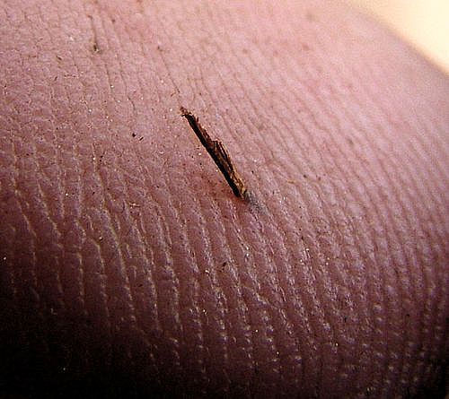 How to Remove a Splinter Under Your Fingernail: 10 Steps